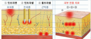 울트라셀 부작용